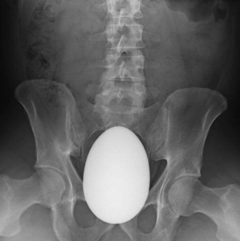 Индийские врачи вытащили из пациентки большое перламутровое яйцо - «Юмор»